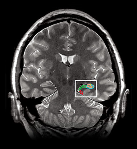 Boscario, Joseph A., “ Posttraumatic Stress Disorder and Mortality Among U.S. Army Veterans30 Years After Military Service” Annals of Epidemiology, Volume 16, New York,Elsevier(2006)