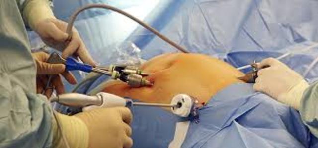 LA CIRUGIA LAPAROSCOPICA SE EXTIENDE POR TODO EL MUNDO