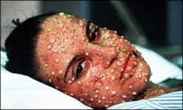 primera gran epidemia de viruela