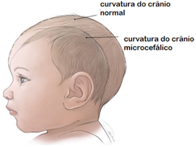 Qual é a relação entre o vírus da zika e a microcefalia? 2015