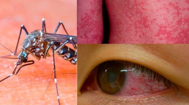 O zika em humanos