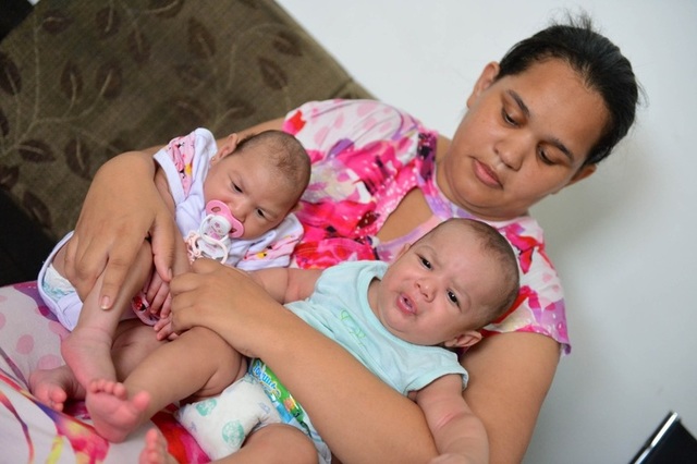 Microcefalia em gêmea