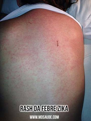 Aparecimento do Zika em humanos