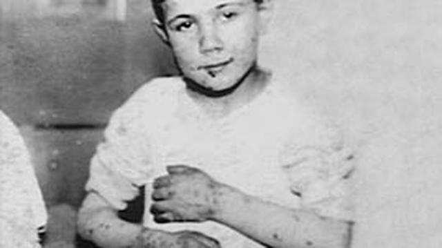 Dysentry, typhus, and scurvy start to spread in the camp