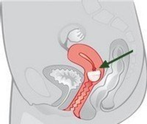 Ouverture clandestine d'un premier centre de planning familial