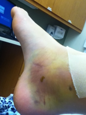 Yo rompí mi tobillo