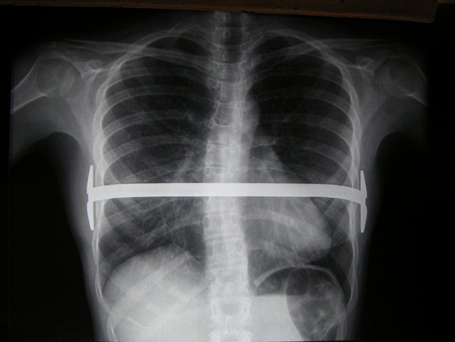 Yo tuve una cirugía.