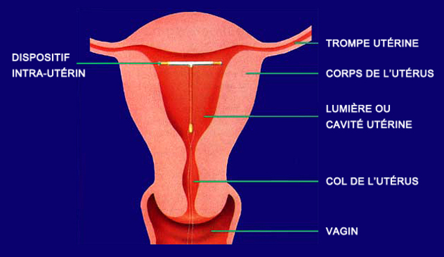 Invention du dispositif intra-utérin au Japon