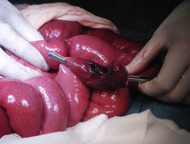 Yo tuve cirugía en mi apéndice