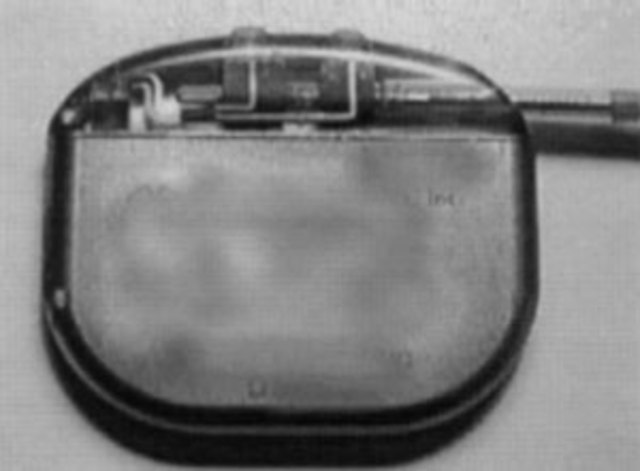Internal pacemaker  invented