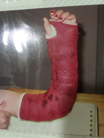 Broke my arm