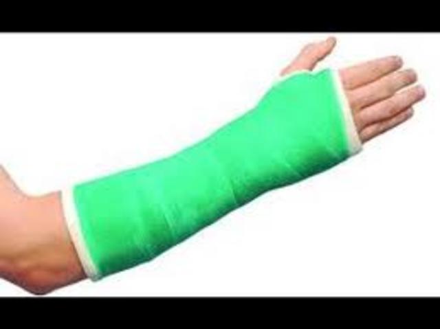 Emma broke her first bone