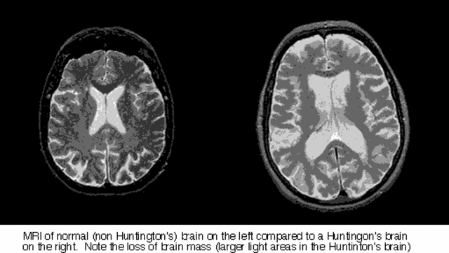 Huntington's disease is the first mapped genetic disease