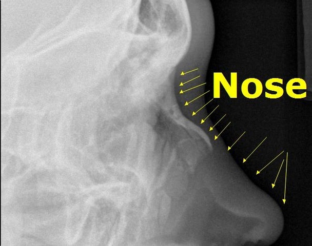 Broke my sisters nose