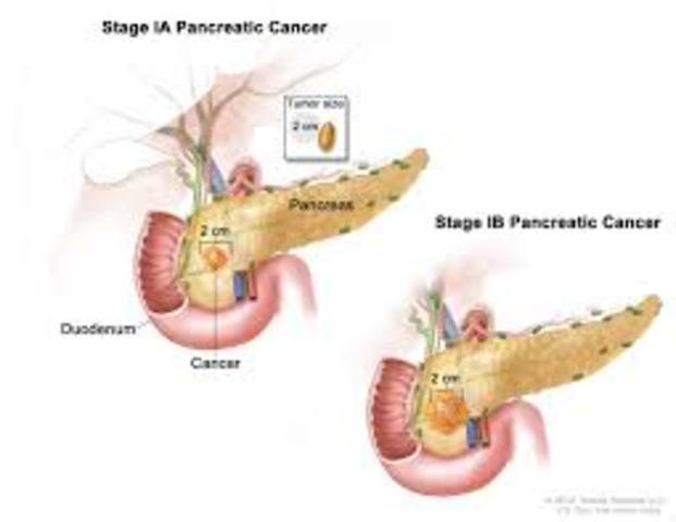 Pancreatic cancer