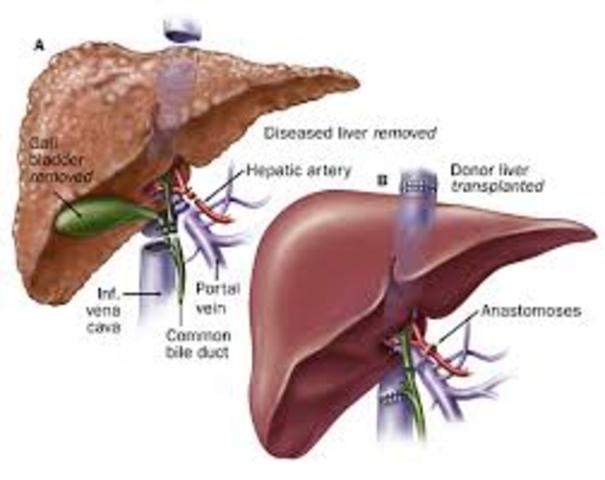 Liver transplant