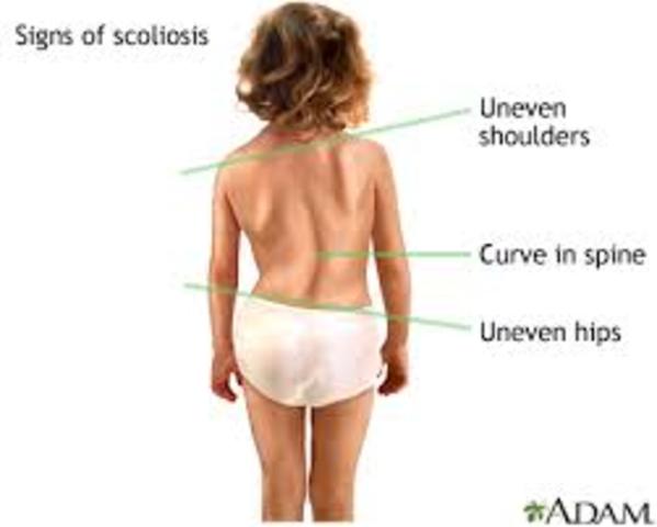 I figured out I had scoliosis