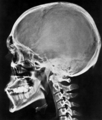 A Röntgen-sugarak felfedezése