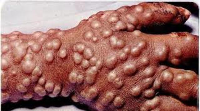 primera gran epidemia de viruela