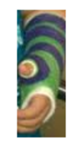 The day I broke My Thumb