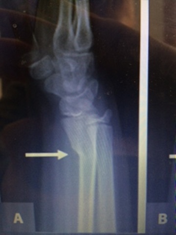 1st Broken bone age 9