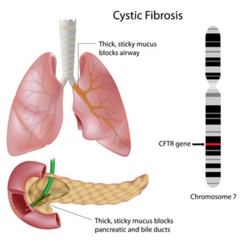 Cystic Fibrosis gene mutation identified