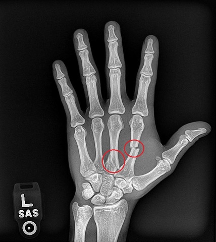 Me fracturé el mano de juegando fútbol.