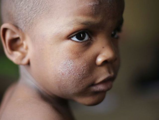 Children in Flnt Exposed