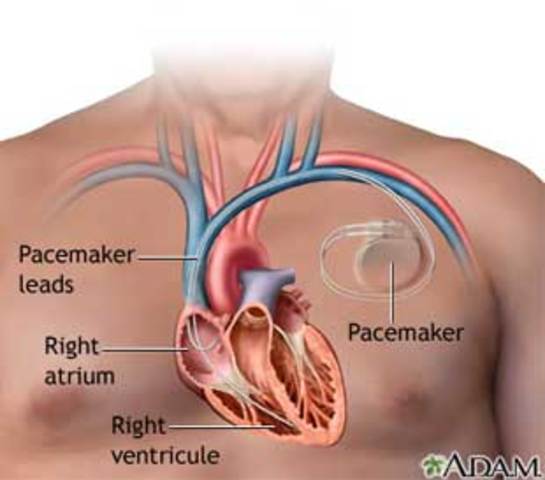 PACEMAKERS