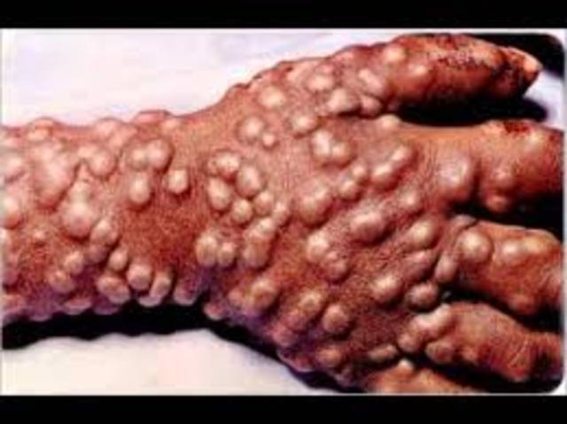 smallpox