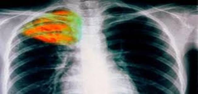 ΦΥΜΑΤΙΩΣΗ-TUBERCULOSIS (BCG)