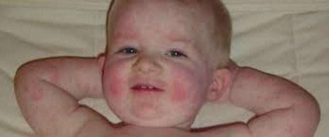 ΕΡΥΘΡΑ-RUBELLA