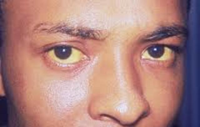 ΗΠΑΤΙΤΙΔΑ Β-HEPATITIS B