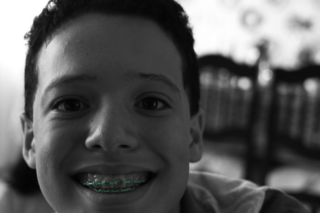 Me colocan los brackets