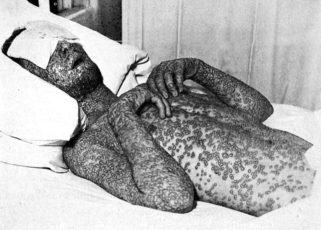 Smallpox Epidemic
