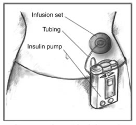 External insulin pump