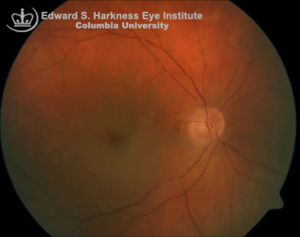 Test with eye exam( looking for clouds in retinal arteries), weaker pulse, urinalysis