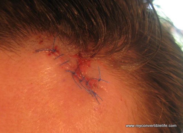 Got stitches