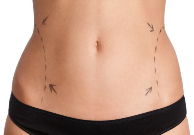 Liposuction