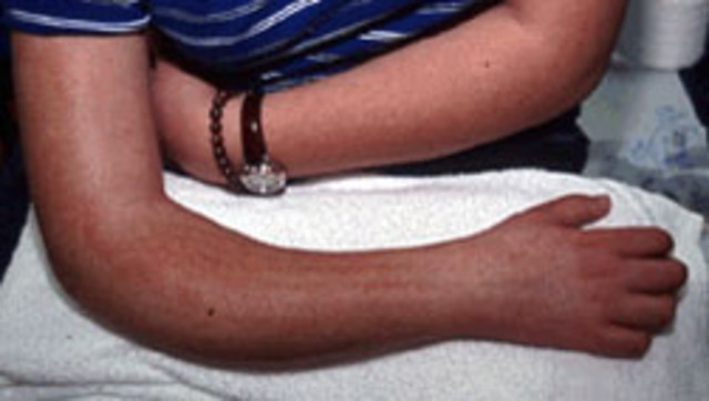 Fractura de un brazo