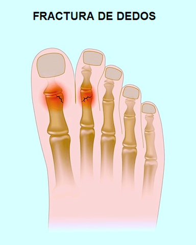 me a rieron el dedo del pie