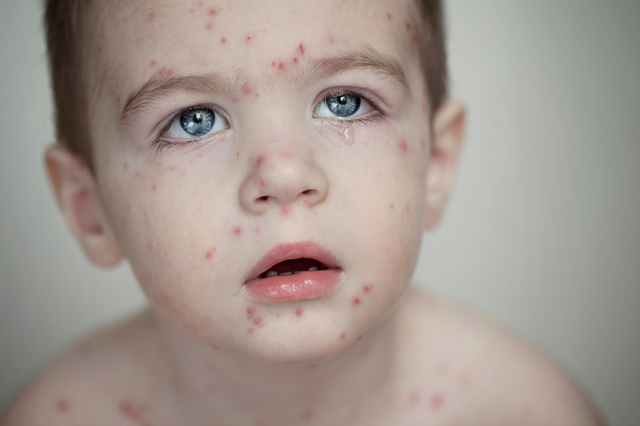 How Chickenpox works