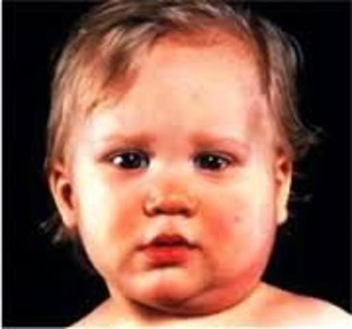 first detailed scientific description about the mumps is written