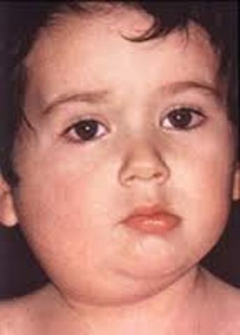 Mumps virus is isolated