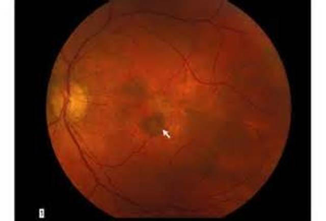 Photodynamic therapy for macular degeneration