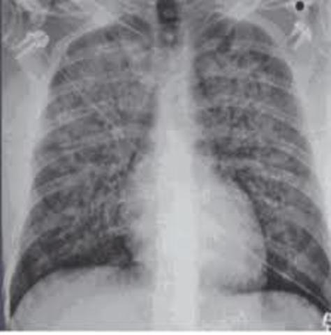 VENTILACION  MECANICA EN SDR