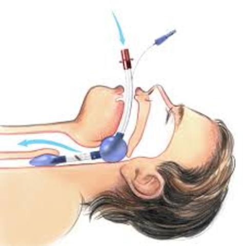 INSERCION DEL TUBO ENDOTRAQUEAL