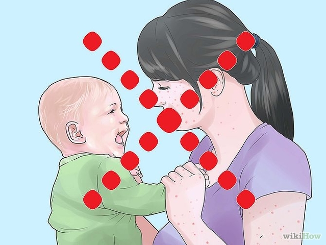 study of exposed people from chickenpox