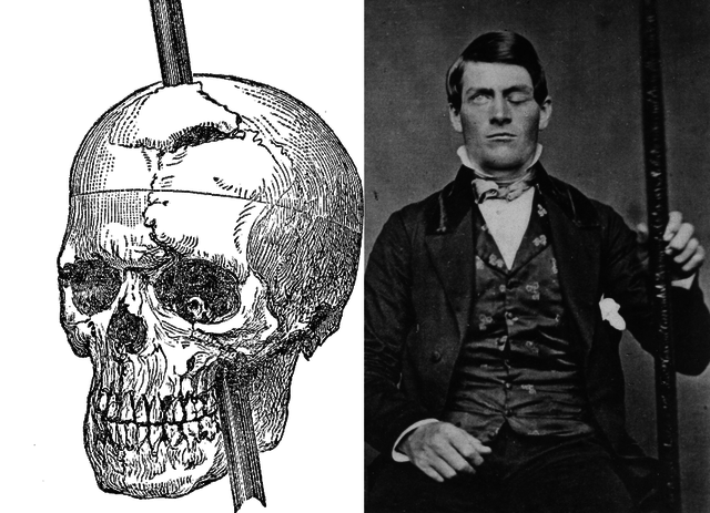 1ER CASO DE LOBOTOMIA