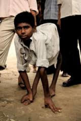 First Polio Outbreak in U.S.